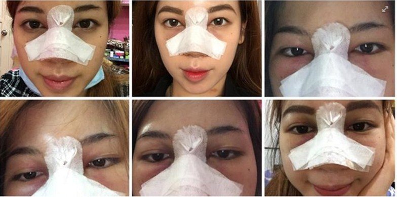 Nâng mũi có ảnh hưởng đến mắt 3