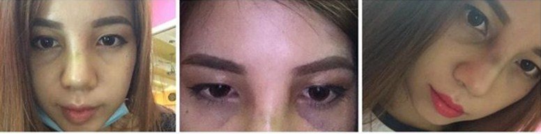 Nâng mũi có ảnh hưởng đến mắt 1