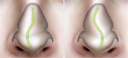 Mũi bị vẹo do sóng mũi Mũi bị vẹo do sóng mũi