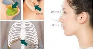 Nâng mũi bằng sụn tai Nâng mũi bằng sụn tại Kangnam