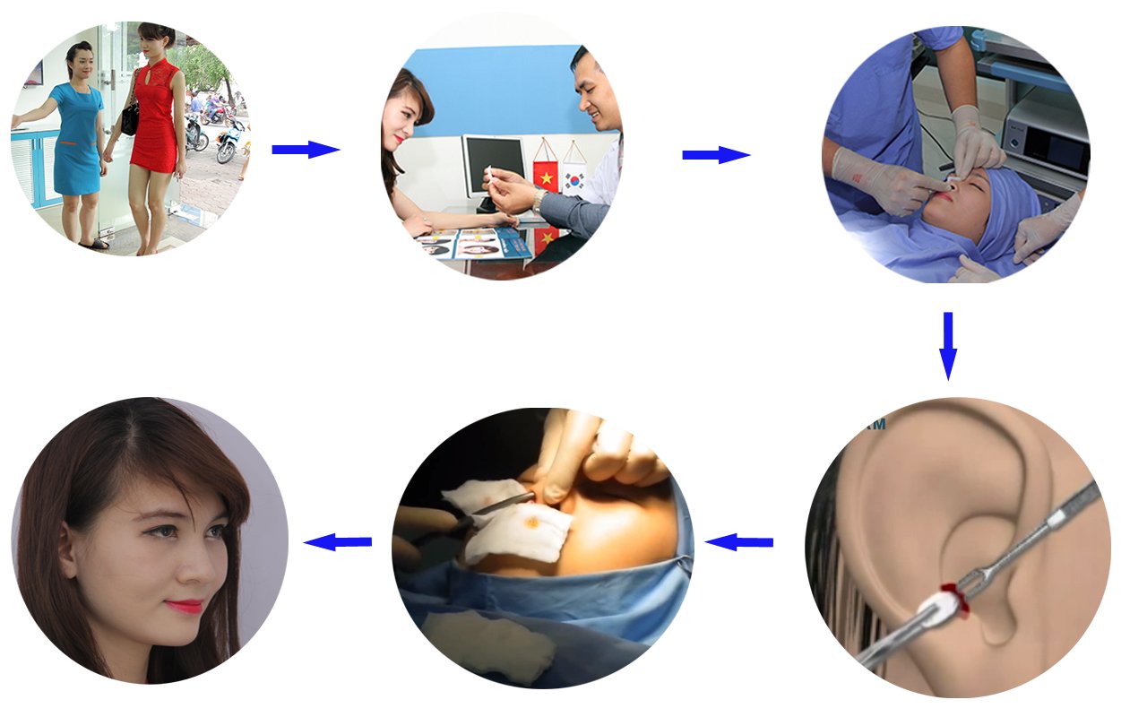 Quy trình nâng mũi bọc sụn mang lại chiếc mũi cao thanh tú, hài hòa, đẹp tự nhiên Phẫu thuật nâng mũi được bao lâu?