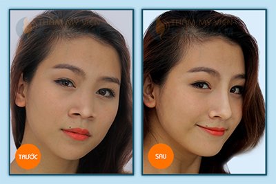 Nâng mũi bằng sụn tự thân an toàn tuyệt đối hiệu quả ổn định, lâu dài. Phẫu thuật nâng mũi được bao lâu?