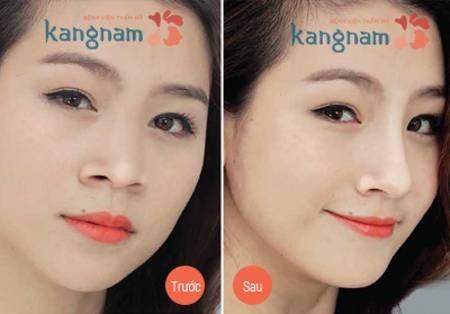 Chi phí phẫu thuật thu gọn cánh mũi nội soi giá bao nhiêu tiền Chi phí phẫu thuật thu gọn cánh mũi nội soi giá bao nhiêu tiền
