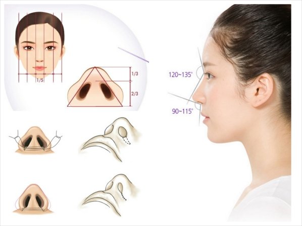Thu gọn cánh mũi đem lại nét đẹp hài hoà tự nhiên cho gương mặt Thu hẹp cánh mũi nội soi hết khoảng bao nhiêu tiền