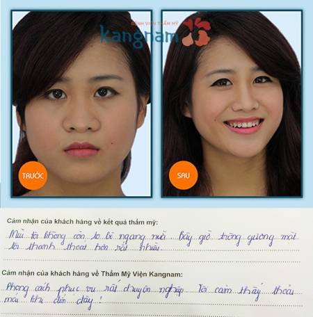 Kết quả của phẫu thuật thu gọn cánh mũi nội soi an toàn tại bệnh viện thẩm mỹ Kangnam Kết quả của phẫu thuật thu gọn cánh mũi nội soi tại Kangnam