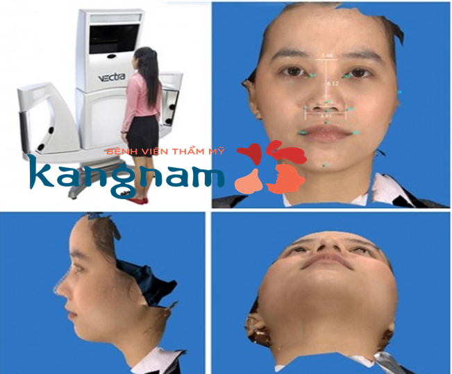 kẹp nâng mũi 2