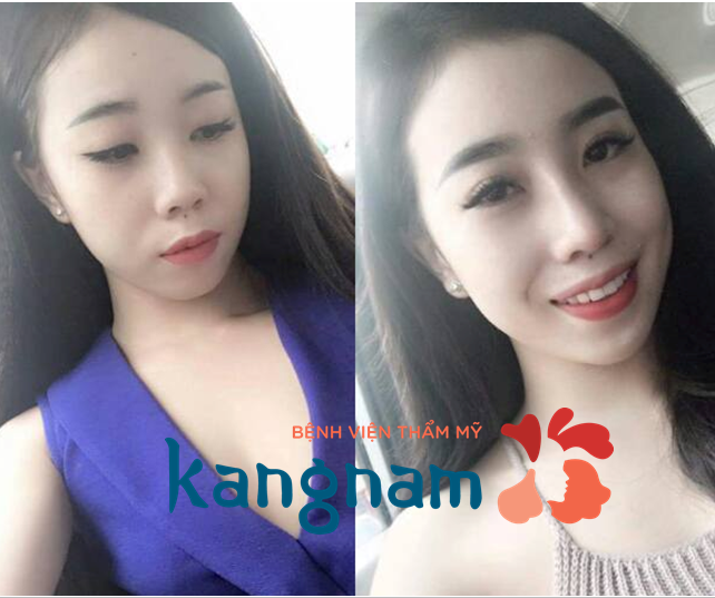 kẹp nâng mũi 4