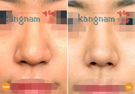 Kết quả phẫu thuật thu gọn cánh mũi nội soi tại bệnh viện thẩm mỹ Kangnam Kết quả phẫu thuật thu gọn cánh mũi nội soi tại bệnh viện thẩm mỹ Kangnam
