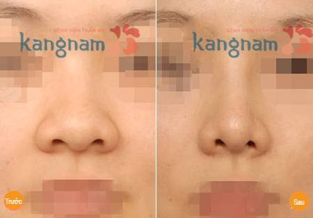 Kết quả phẫu thuật thu gọn cánh mũi nội soi tại thẩm mỹ viện Kangnam Kết quả phẫu thuật thu gọn cánh mũi nội soi tại Kangnam