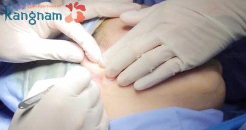 Sử dụng sụn tự thân bao bọc, bảo vệ đầu mũi Nâng mũi có được vĩnh viễn không, nâng mũi bọc sụn có vĩnh viễn không?
