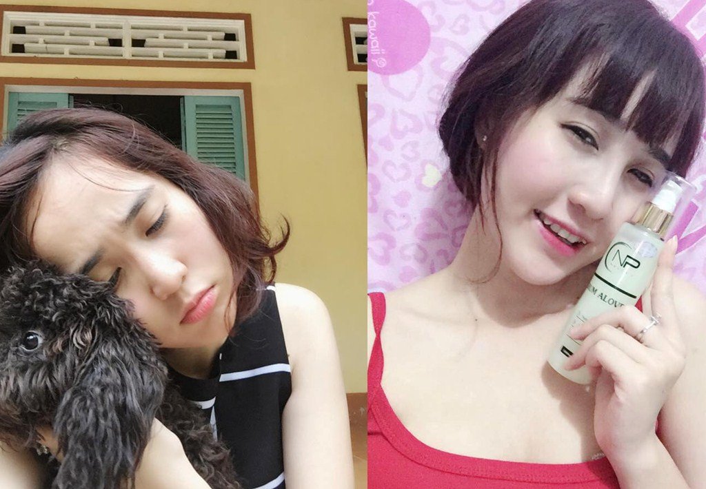 Kiều Trang trước và sau sửa mũi Hàn Quốc tại Kangnam nâng mũi Hàn Quốc
