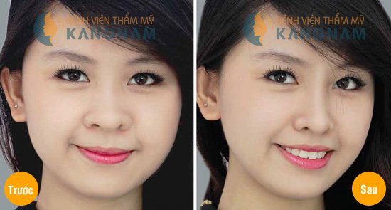 Kết quả khách hàng cắt cánh mũi tại Kangnam làm mũi nhỏ