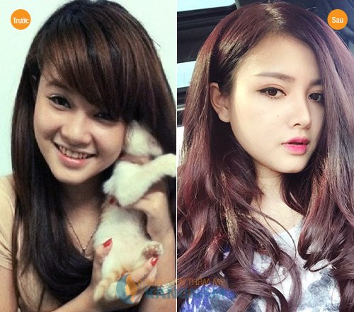 Kết quả khách hàng nâng mũi S line 3D tại Kangnam mui cao la nhu the nao