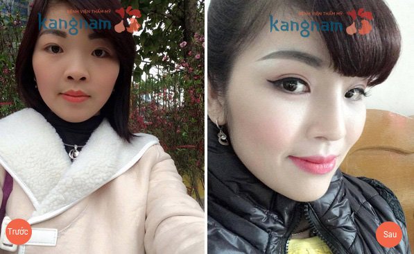 Kết quả nâng mũi bọc sụn tại Kangnam Nâng mũi bọc sụn có vĩnh viễn không?