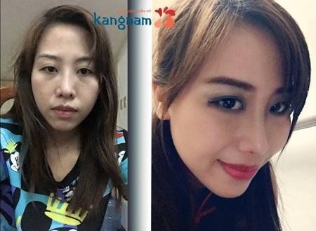 Kết quả sau khi sửa sống mũi bị lệch mũi bị vẹo vách ngăn tại Kangnam Kết quả sau khi sửa sống mũi bị lệch mũi bị vẹo vách ngăn tại Kangnam