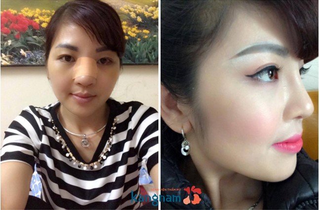 Kéo dài đầu mũi
