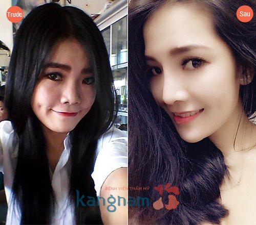 Nâng mũi có ảnh hưởng đến mắt 4