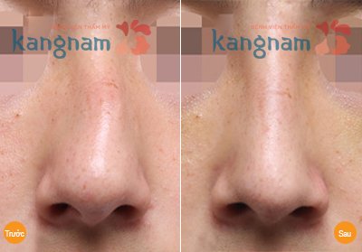 Kết quả 1 khách hàng sửa mũi lệch do phẫu thuật hỏng sửa mũi lệch