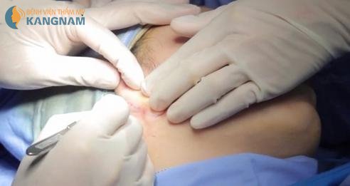 sụn nâng mũi S line 3D 5