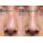 Nắn lại sống mũi bị lệch được không? Chia sẻ cách nắn mũi bị lệch tại Kangnam