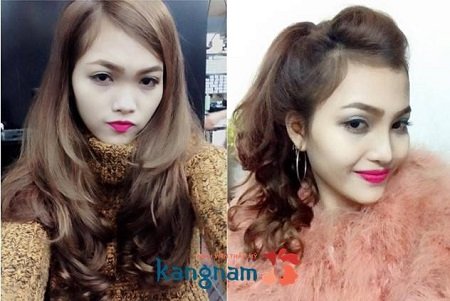 Xinh đẹp hơn sau phẫu thuật nâng mũi