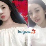 Sửa mũi S line bao lâu mới cắt chỉ? Bác sĩ tư vấn