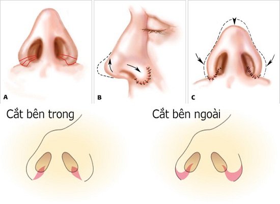Hình ảnh minh họa hai phương pháp thu gọn cánh mũi Thu gọn cánh mũi bằng cách nội soi