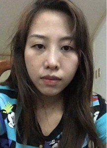 Nâng mũi xong bị lệch thì phải làm sao?