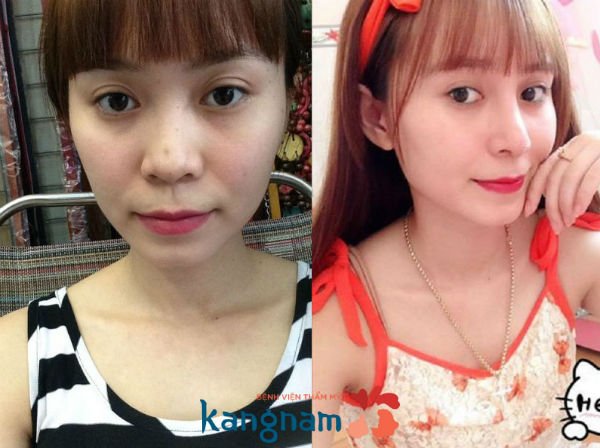 nâng mũi xong bị lệch 3