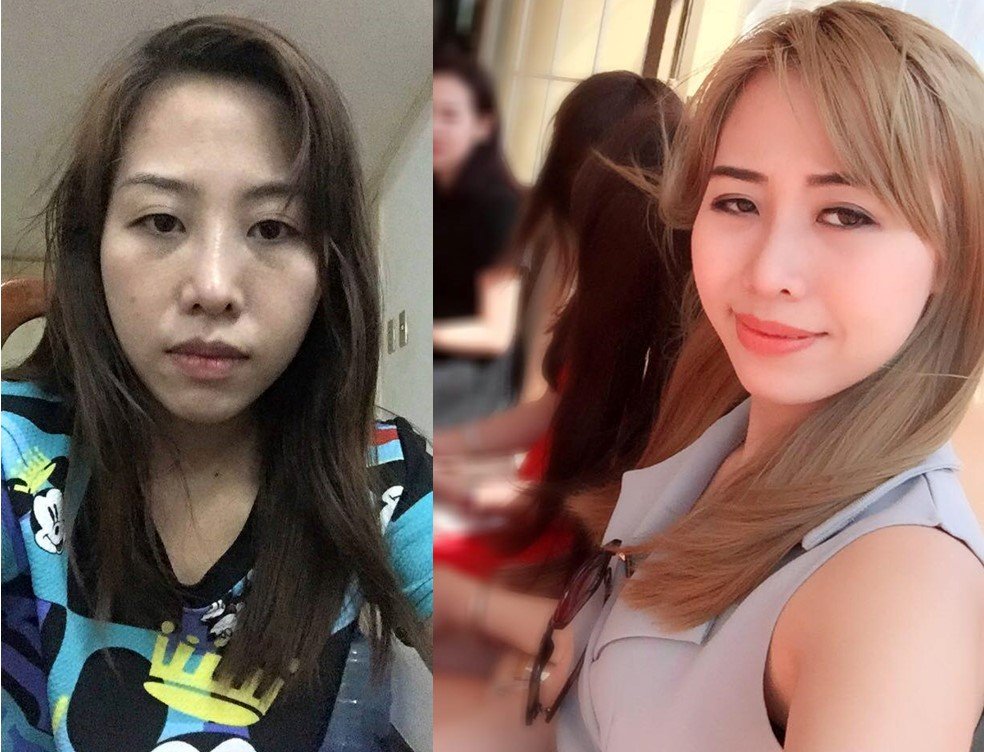 nâng mũi xong bị lệch 4