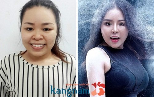 Nâng mũi có nên không 3
