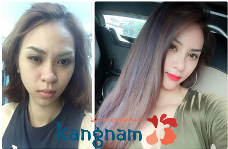 Sau nâng mũi bao lâu thì được đeo kính 4