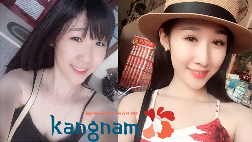 Kết quả nâng mũi thẩm mỹ tại bệnh viện thẩm mỹ Kangnam Giá phẫu thuật nâng mũi hết bao nhiêu tiền