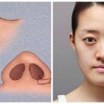 Khi nào thì nên cắt cánh mũi – Hỏi đáp chuyên gia