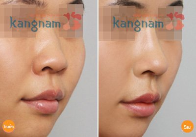 Nâng mũi không phẫu thuật giá bao nhiêu 2
