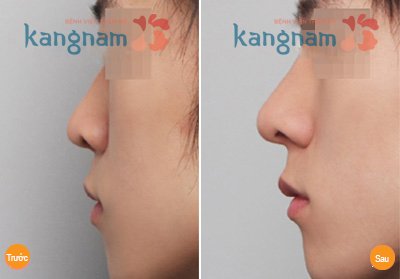 Nâng mũi không phẫu thuật giá bao nhiêu 3