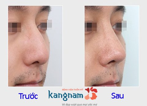 Hình ảnh trước và sau nâng mũi333
