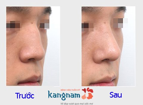 Hình ảnh trước và sau nâng mũi133