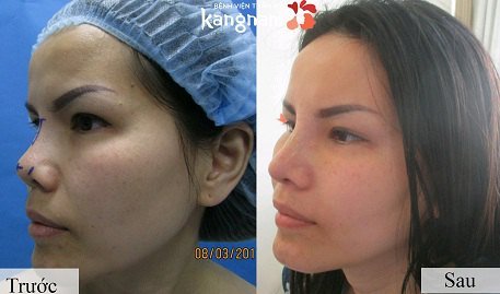 Hình ảnh trước và sau nâng mũi444