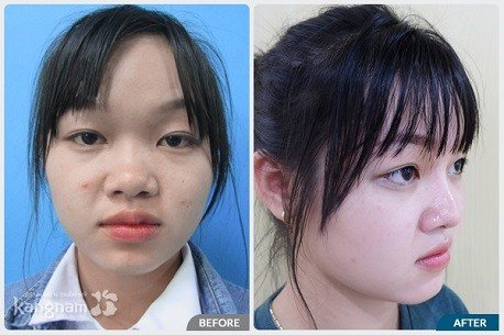 Hình ảnh trước và sau nâng mũi88