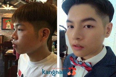 Kết quả trước sau nâng mũi tại Kangnam