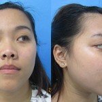 Chẳng những không đẹp, người mũi hếch còn gặp khó khăn thế này…