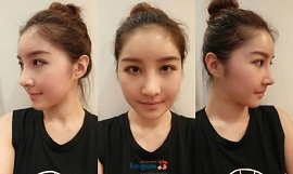 Giá nâng mũi bọc sụn Hàn Quốc bao nhiêu tiền, có đắt lắm không?