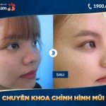 10 lợi ích của phẫu thuật nâng mũi bạn đã biết?