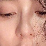 Sống mũi gãy là như thế nào? Gãy sống mũi phải làm sao khắc phục?