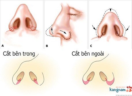 Mô phỏng kỹ thuật thu gọn cánh mũi (A: Cãnh múi mỏng - B: Cánh mũi to dày) thu gọn cánh mũi có để lại sẹo không 6