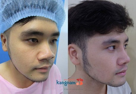 Chúng ta hoàn toàn không nhìn thấy bất kỳ vết sẹo nào trên cánh mũi anh ấy thu gọn cánh mũi có để lại sẹo không 4