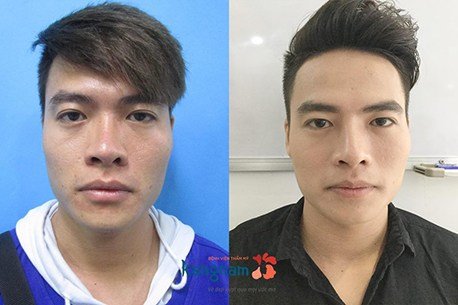 Hình ảnh khách hàng trước và sau thực hiện cắt cánh mũi nội soi tại Kangnam thu nhỏ cánh mũi có để lại sẹo không 1