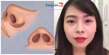 Thu gọn cánh mũi không để lại sẹo? thu nhỏ cánh mũi có để lại sẹo không 2