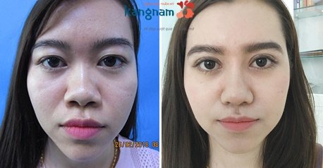 Kết quả sau 1 tháng thu gọn cánh mũi - Mũi đẹp tự nhiên, không lộ dấy vết thẩm mỹ thu nhỏ cánh mũi có để lại sẹo không 3